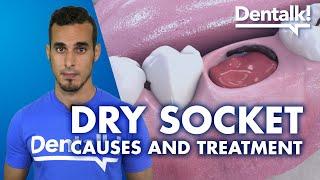 DRY SOCKET – Symptoms treatment and causes of INFECTED tooth extraction  Dentalk ©