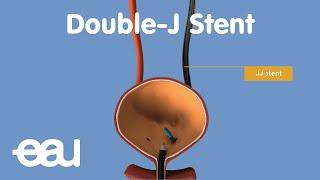 JJ Stent removal of kidney stones