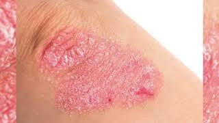 Symptoms and first signs of psoriasis pictures in women men and children