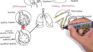 Chronic Obstructive Pulmonary Disease Overview types pathology treatment