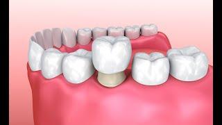 Восстановление зуба пломба или коронка