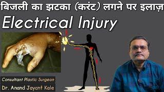 Electrical Injury - बिजली से जलने के वैज्ञानिक उपचार  बिजली का झटका करंट लगने पर इलाज़