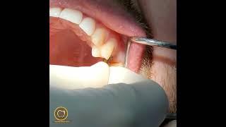 DENTAL IMPLANTS WITHOUT SURGERY -  in 15 minutes all process  completed@GoldenSmileDent