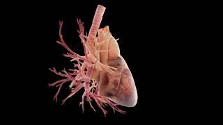 Medizinische 3D Animation. Unser Herz. Herzinfarkt