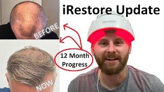 IRESTORE LASER HAIR GROWTH THERAPY 12 - MONTH UPDATE  Before and After Comparison