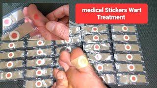 Foot Wart Corn Removal Using Medical Stickers From Aliexpress Do They Work?