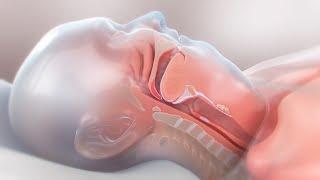 Obstructive Sleep Apnea  medical animation