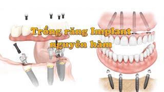 Trồng răng implant nguyên hàm - Cấy ghép răng implant toàn hàm