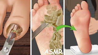 ASMR Ingrown Toenail Removal Treatment Animation  WOW Brain Deep Clean Treatment