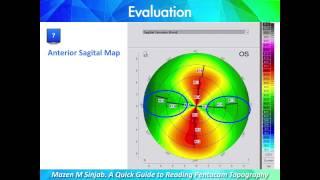 A Quick Guide to Reading Corneal Topography. Part 1
