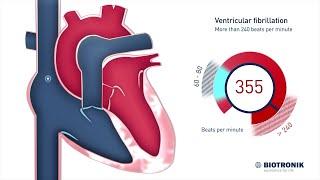 Fibrilação Ventricular e Morte Cardíaca Súbita