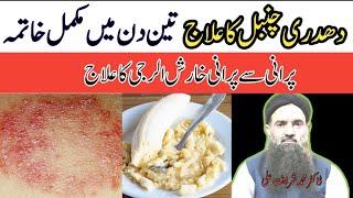 How to remove fungal infection Urduhindi  DaadDadri ka ilaj  Ringworm removal   Dr Sharafat Ali
