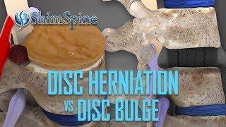 Disc Herniation vs Disc Bulge