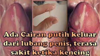 Ada Cairan putih keluar dari lubang penis  terasa sakit ketika kencing