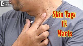 What Causes Skin Tags And Warts?  Get Rid of Warts & Skin Tags- Dr. Renuka Shetty  Doctors Circle