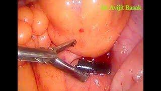 Broken Instrument Removal During Laparoscopy by Dr.Avijit Basak