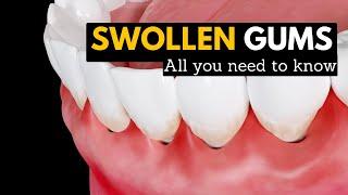 Swollen Gums Explained What You Need to Know and How to Treat Them