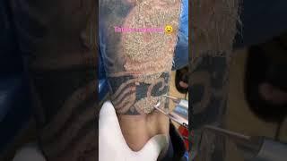 tattoo removal ️#shorts #tattoo #tattooartist #tattooart #trending #tattoolover #subscribe