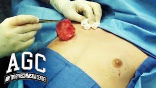 Gynecomastia Removal in Adolescent Male - Dr. Robert Caridi - Austin Gynecomastia Center