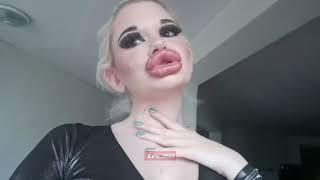 Woman with biggest lips in the world