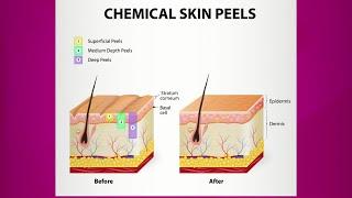 Chemical Peel Purpose & Types