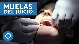 CUIDADOS después de la extracción de las MUELAS DEL JUICIO