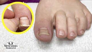 Ingrown Toenail Recovery and Prevention