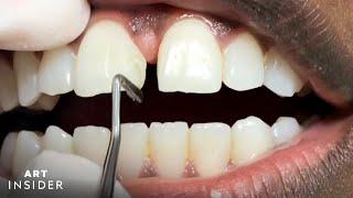 How Tooth Gaps Are Filled  Insider Art