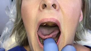 Evaluation of compensation patterns for patients with posterior tongue-tie.