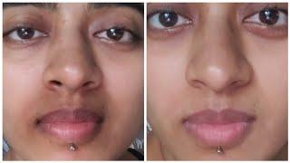 How I ACTUALLY got Rid of Pigmentation Around my Mouth  Pigmentation Treatment For Mouth Darkness