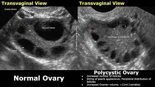 Ovary Ultrasound Normal Vs Polycystic Ovarian Syndrome PCOS Images  String Of Pearls Sign Ovaries