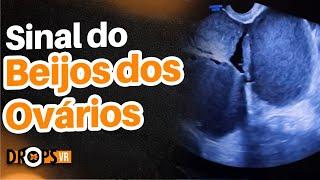 SINAL DO BEIJOS DOS OVÁRIOS - COMO RECONHECER NO USG? I DR. MICHEL PALHETA I VOCÊ RADIOLOGISTA