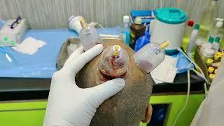 Wet Cupping  Hijama therapy for hair growth.