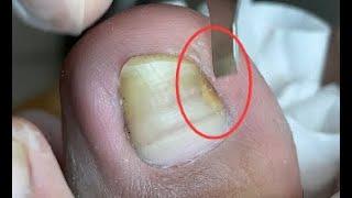 Deformed nail repair