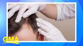 New study finds some natural hair loss remedies may work  GMA