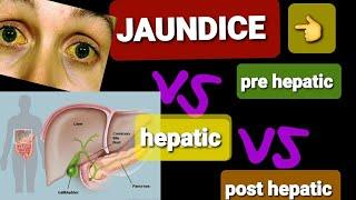 JAUNDICE  PRE HEPATIC VS POST HEPATIC JAUNDICE  DR SHAHRUKH