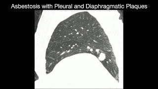 Asbestosis with Pleural and Diaphragmatic Plaques