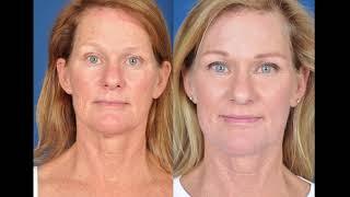 Renuvion J-Plasma Procedures - Denver CO Plastic Surgery