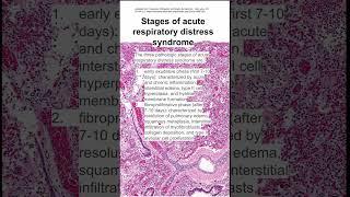 Stages of acute respiratory distress syndrome