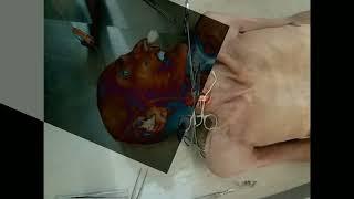 Common carotid Arterial Embalming Procedure