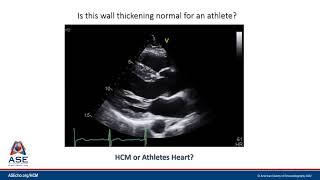 HCM Microlesson Case Example #2 HCM versus Athletes Heart