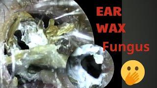 Ear wax removal 1009 - Terrible Ear wax and Fungus