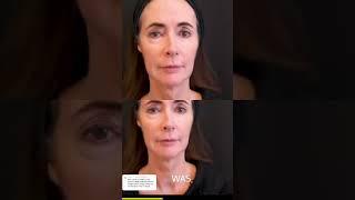 Sculptra treatment for elasticity and collagen 