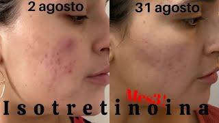 Isotretinoina mes tres  isotretinoina 20 mg para curar acné  Roacutan  Mi historia con el acne