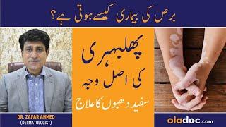 Phulbehri Ka Ilaj In Urdu - Vitiligo Symptoms Causes & Treatment - Safed Nishan Kyun Hote Hain