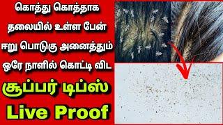 தலையில் உள்ள மொத்த ஈறு பேன் பொடுகு ஒரே நாளில் கொட்டி விட சூப்பர் ஐடியாdandruff tipFathus Samayal