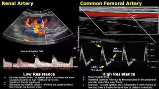 Difference Between Low Resistance & High Resistance Waveforms On Spectral Doppler Ultrasound USG