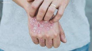 Understanding and treating psoriasis