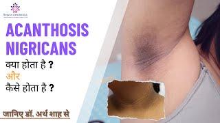 Acanthosis Nigricans एकैंथोसिस निगरिकन्स त्वचा पर काले धब्बे का क्या कारण है?