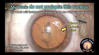 CataractCoach™1815 My Week do not prolapse this nucleus